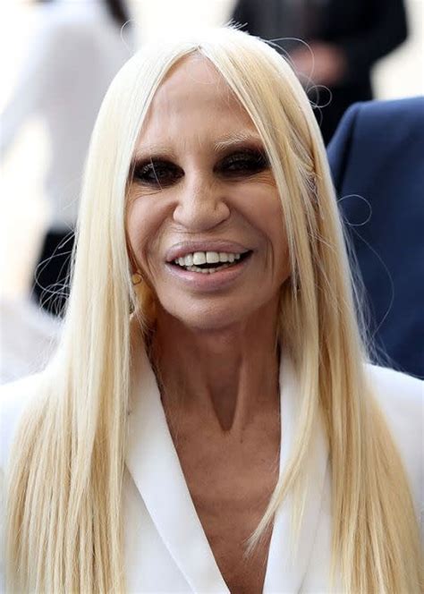 donatella Versace facial scar